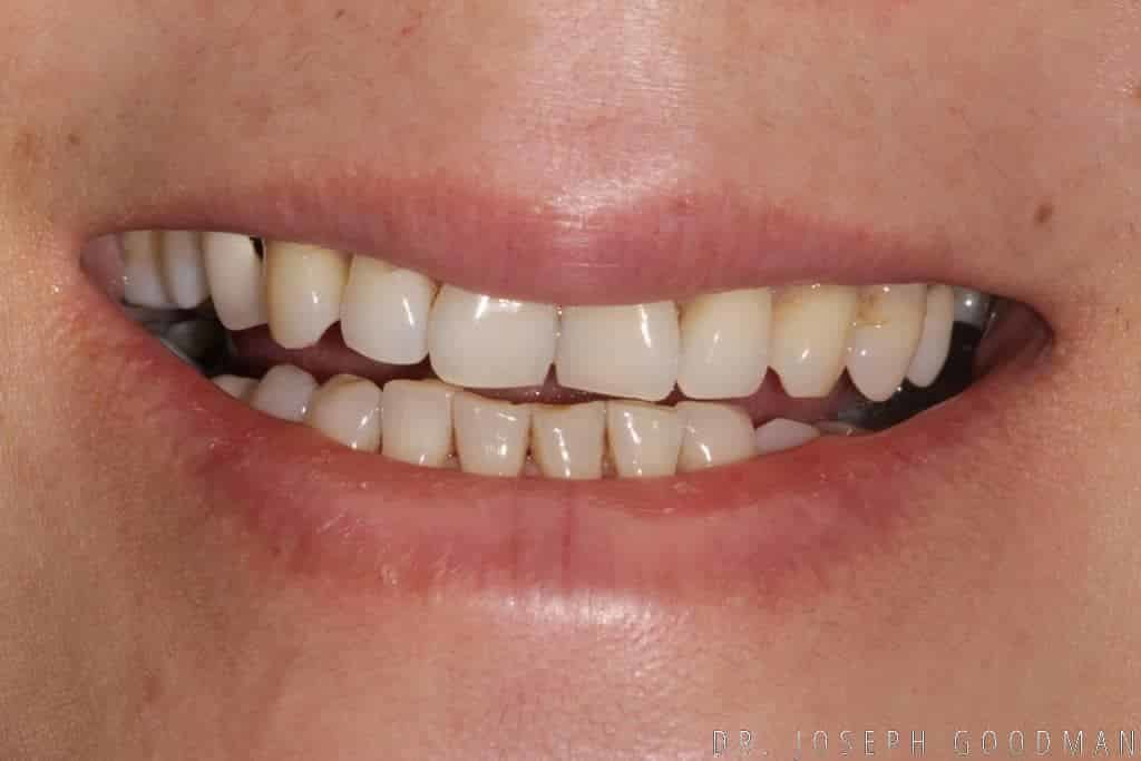 A picture of a client before receiving a smile makeover with 20 porcelain veneers, done by Dr. Joseph Goodman.