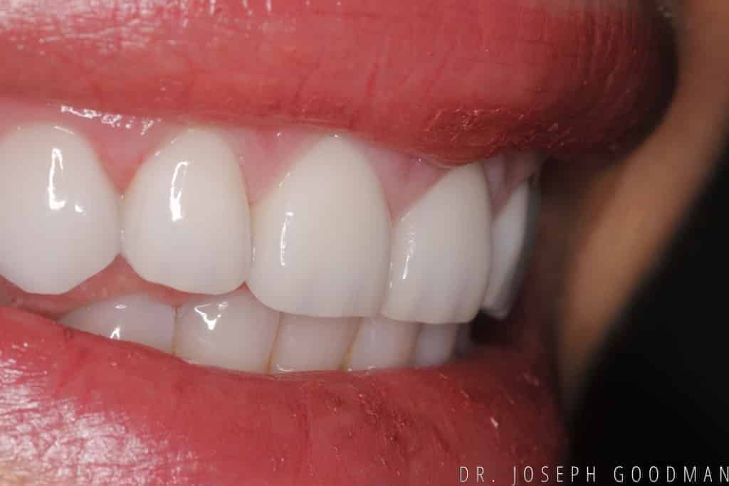 A picture of a client after receiving a smile makeover with 20 porcelain veneers to fix overly large teeth, done by Dr. Joseph Goodman.