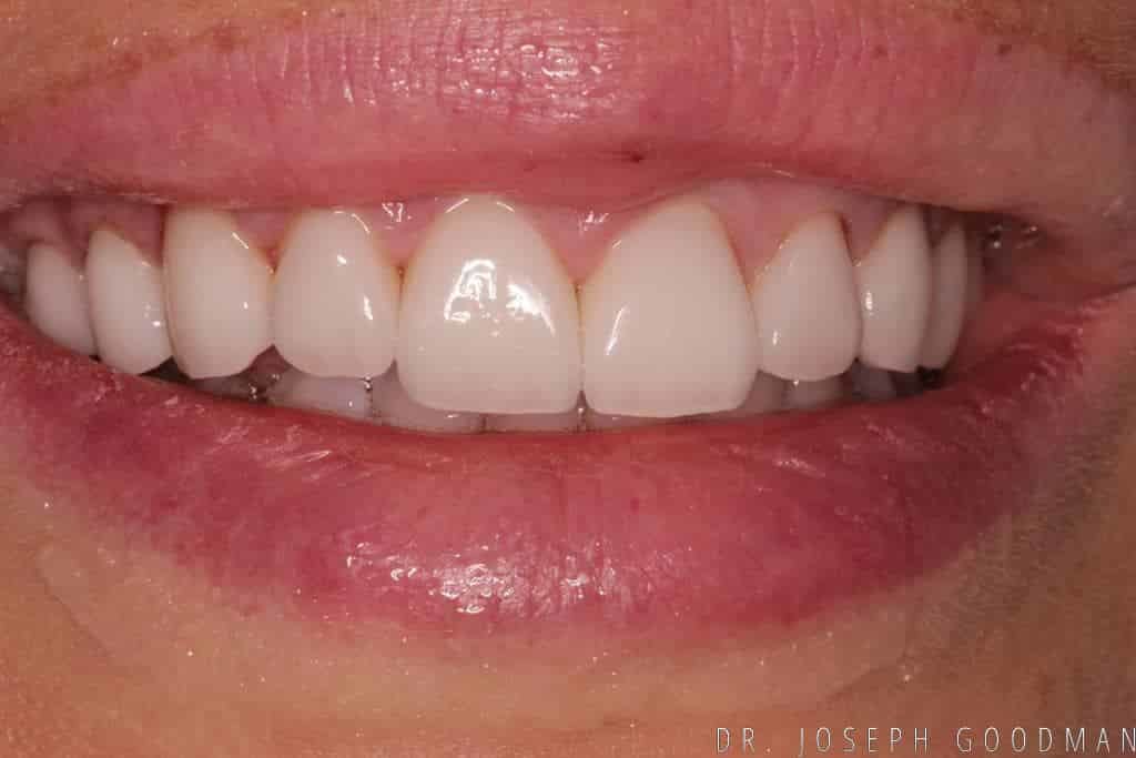 A picture of a client before receiving a smile makeover with 20 porcelain veneers to fix overly large teeth, done by Dr. Joseph Goodman.
