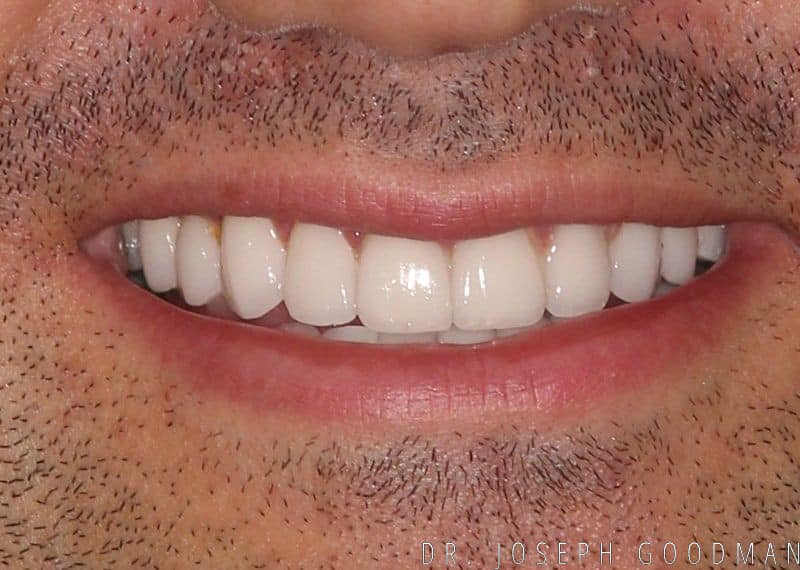 A picture of a man after receiving a smile makeover with 10 porcelain veneers to fix old dental bondings and dull colors from a previous procedure, done by Dr. Joseph Goodman.