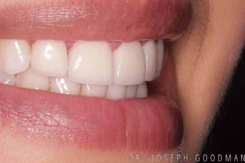 A picture of a woman after receiving a smile makeover with porcelain veneers, done by Dr. Joseph Goodman.