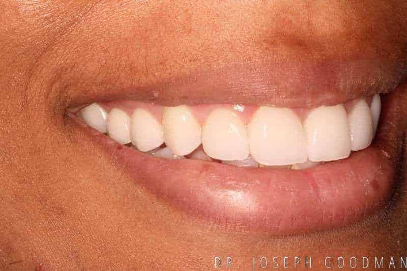 A picture of a client after receiving a smile makeover with 10 porcelain veneers to brighten their smile, done by Dr. Joseph Goodman.