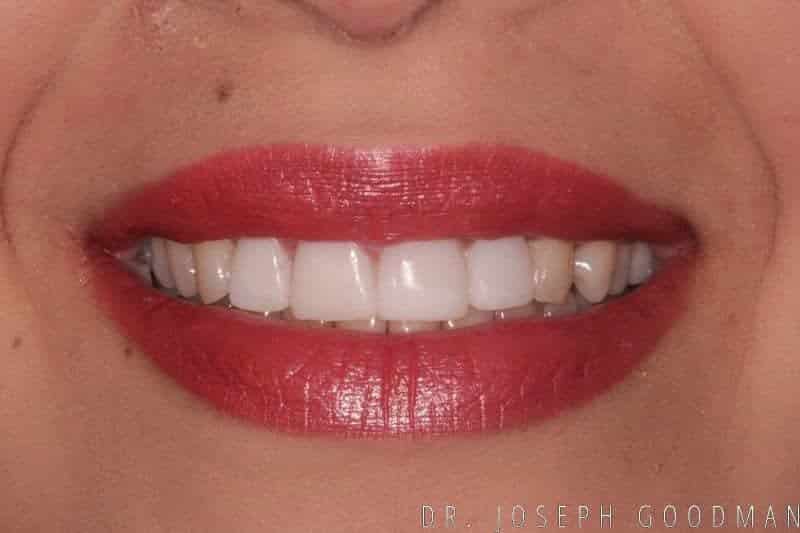 A picture of a woman before receiving a smile makeover with porcelain veneers, done by Dr. Joseph Goodman.