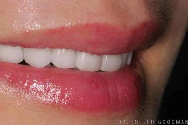 Angel with Veneers After Photo