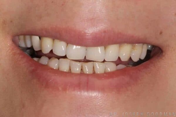 Angel without Veneers Before Photo