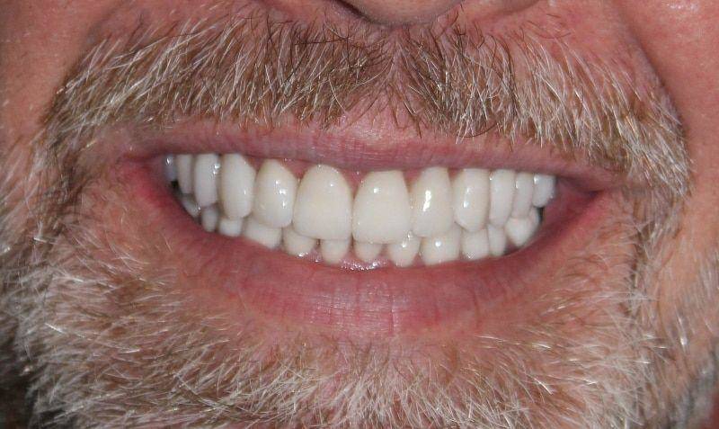 Mike After Veneers