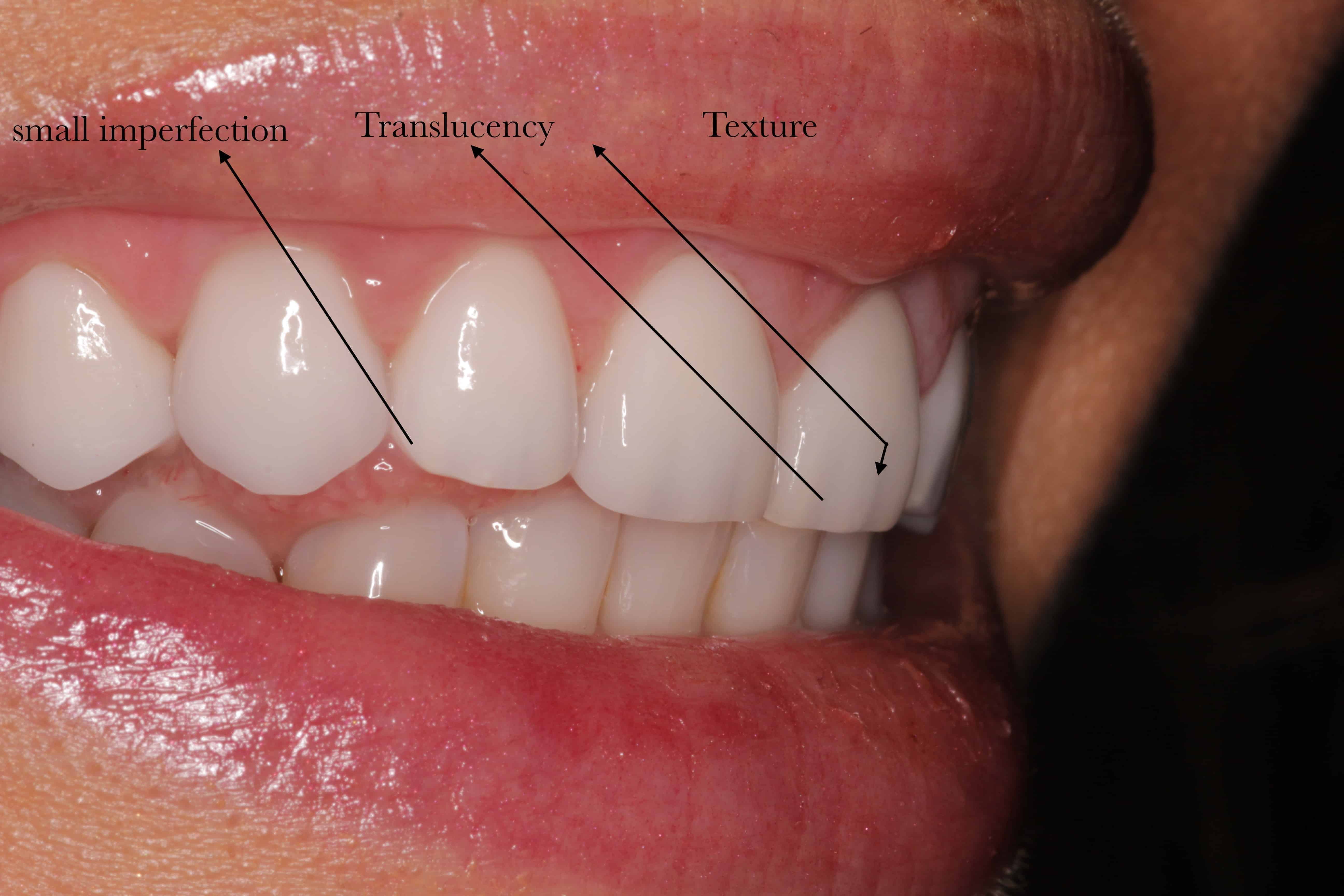 Sample of Veneers