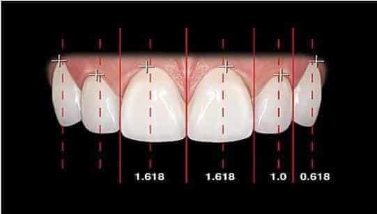 Beverly Hills Veneer Dentist Golden Proportion