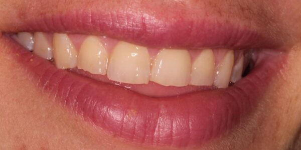 Veneers After Photo