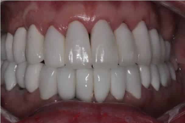 Veneers