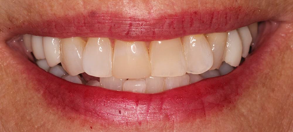 A picture of a client before receiving an instant orthodontics procedure for their smile makeover, done by Dr. Joseph Goodman.