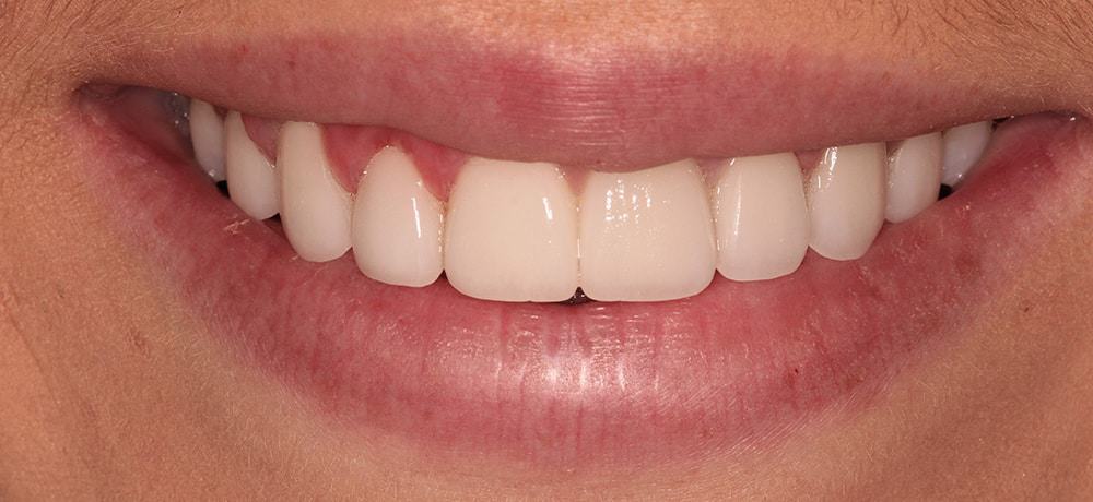 A picture of a beauty pageant client after receiving a translucent veneers procedure with Dr. Joseph Goodman.