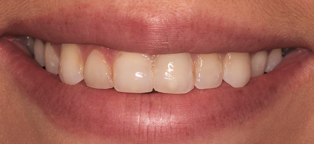 A picture of a beauty pageant client before receiving a translucent veneers procedure with Dr. Joseph Goodman.