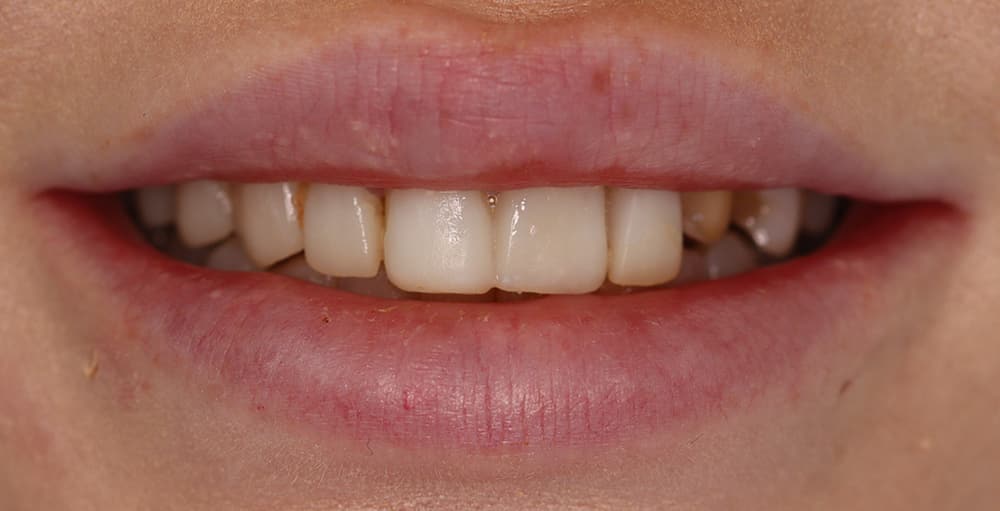 A picture of a client before receiving a smile makeover with porcelain veneers to correct tooth discoloration, done by Dr. Joseph Goodman.