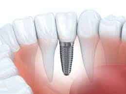 Dental implant and dental roots