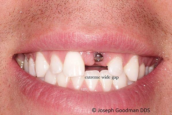 single tooth implant replacement before picture