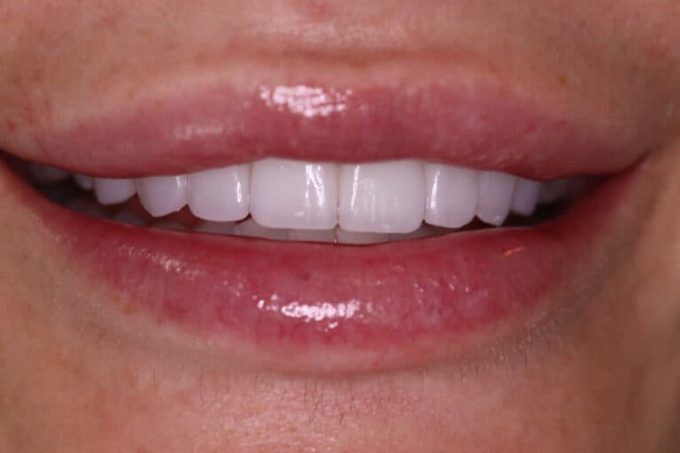 A picture of a client after receiving a smile makeover with full veneers procedure, done by Dr. Joseph Goodman.