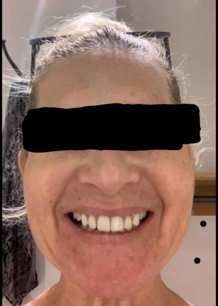 Patient with Implant Denture from Mexico