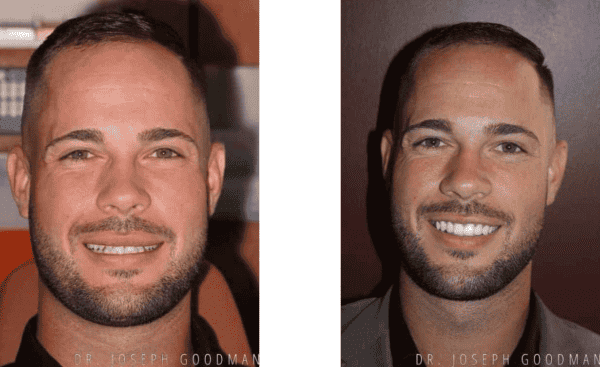 before and after: Porcelain Veneers to Correct Spaces and Size