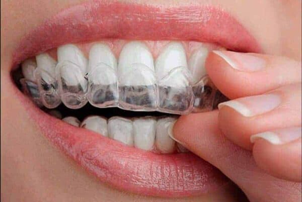 invisalign trays from Dr. Goodman