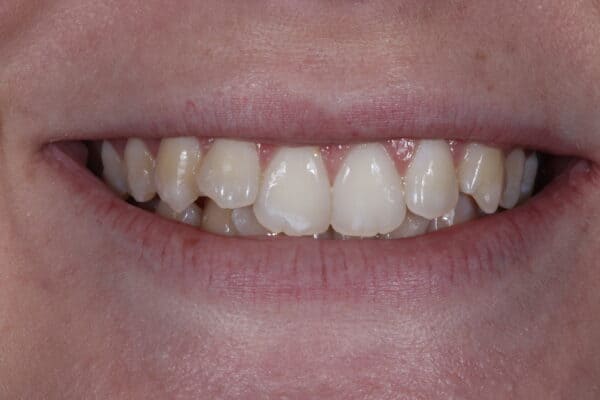 lady smiling before having instant orthodontics from Dr. Goodman