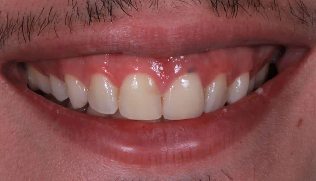 patient before photo with yellow teeth