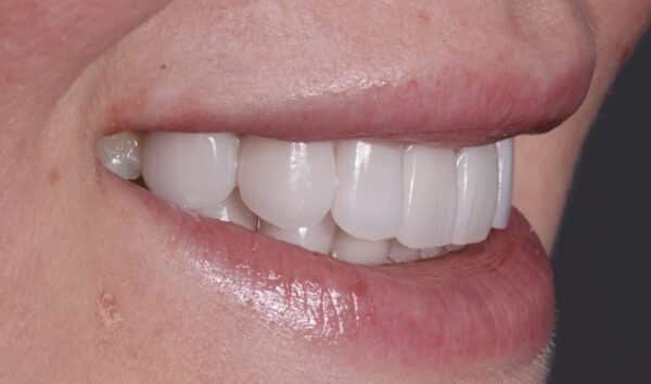 Lady smiling after instant orthodontics from Dr. Goodman
