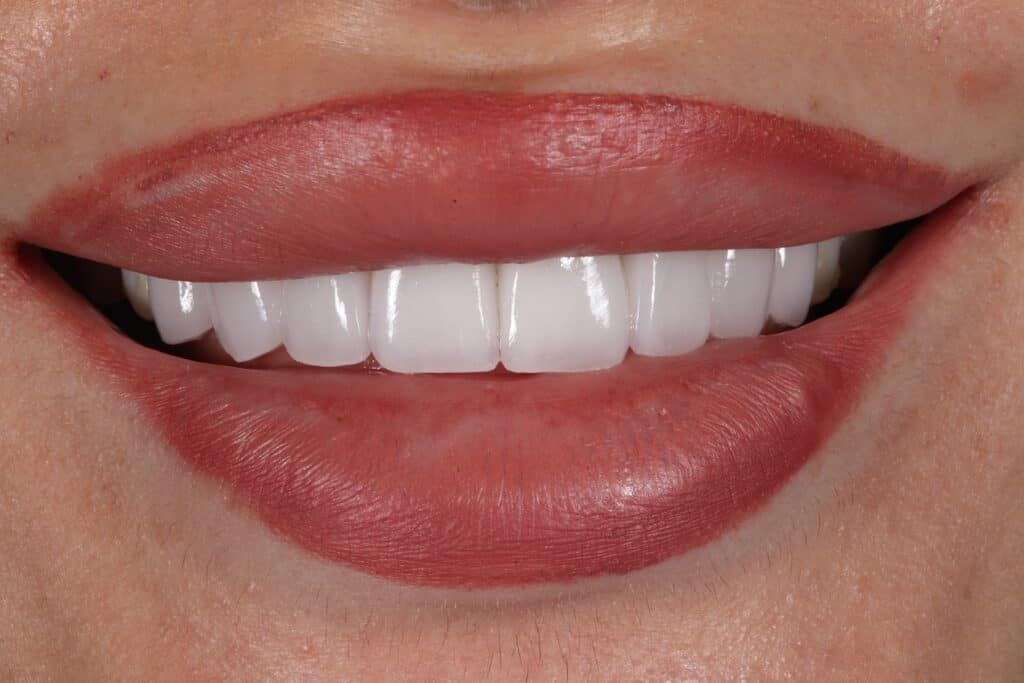 A picture of a woman after receiving a smile makeover with porcelain veneers in shade OM2, done by Dr. Joseph Goodman.