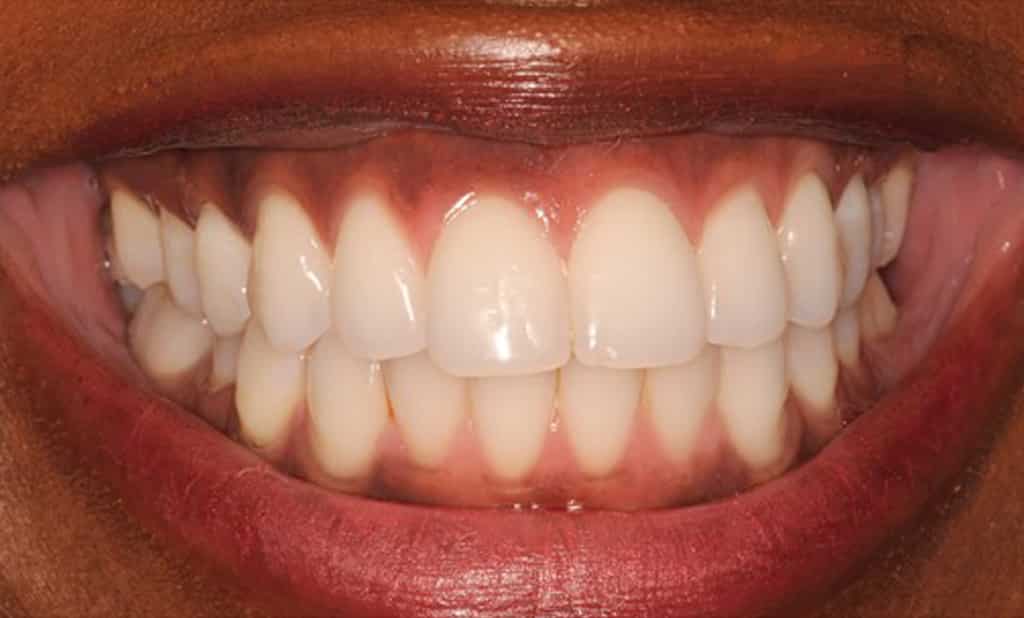 A picture of a man before receiving a gum bleaching procedure by Dr. Joseph Goodman, the result will be permanent for life.
