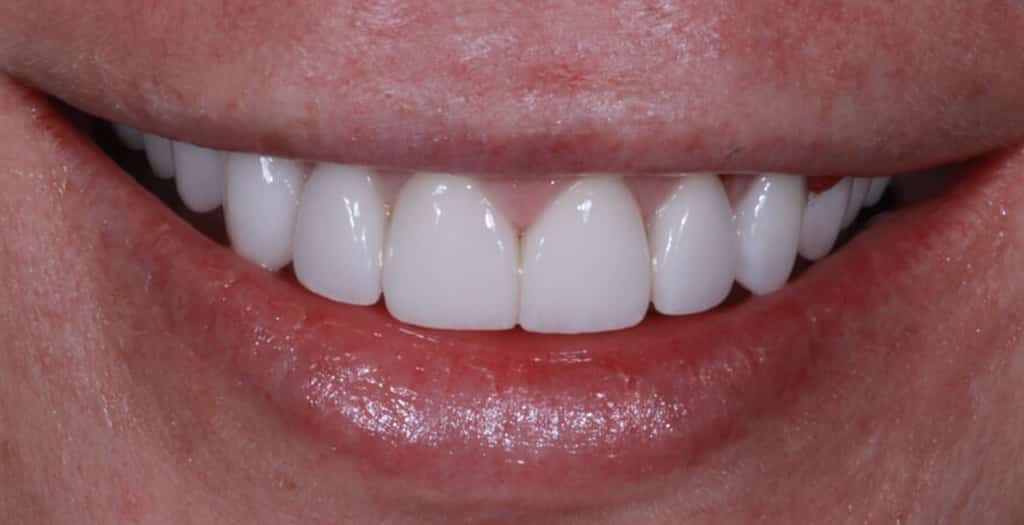 A picture of a client after receiving a smile makeover with porcelain veneers, done by Dr. Joseph Goodman.