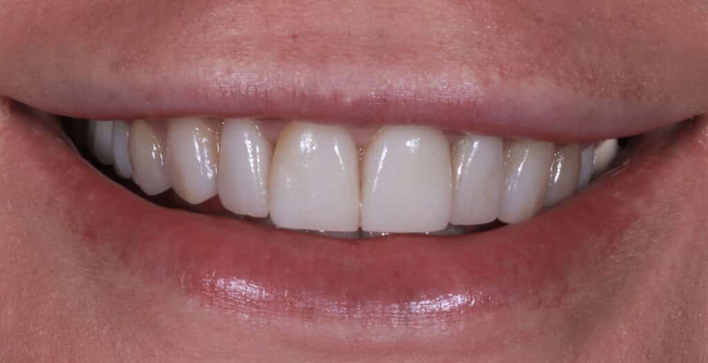 A picture of a client before receiving a smile makeover with porcelain veneers, done by Dr. Joseph Goodman.