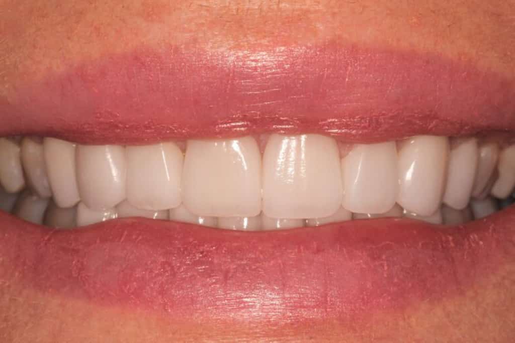 A picture of a client after receiving a smile makeover with 12 upper veneers, done by Dr. Joseph Goodman.