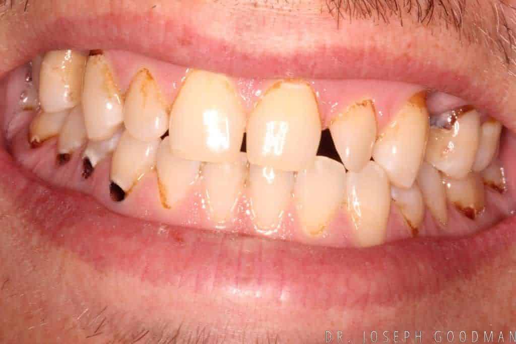 A picture of a client before receiving a smile makeover with 28 porcelain veneers and crowns, done by Dr. Joseph Goodman.