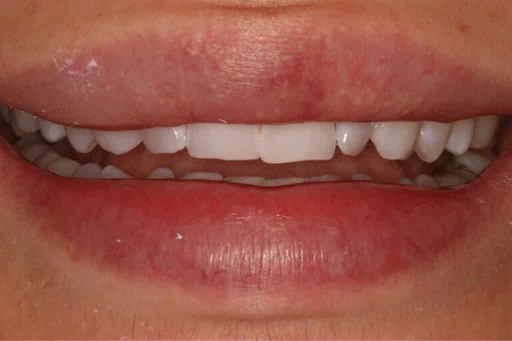 A picture of a woman before receiving a smile makeover with porcelain veneers in shade OM2, done by Dr. Joseph Goodman.