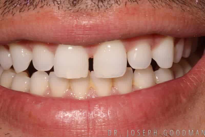 A picture of a client before receiving a smile makeover with porcelain veneers to fix large gaps and spaces in teeth, done by Dr. Joseph Goodman.
