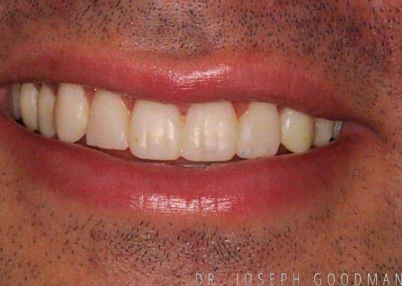 A picture of a man before receiving a smile makeover with 10 porcelain veneers to fix old dental bondings and dull colors from a previous procedure, done by Dr. Joseph Goodman.