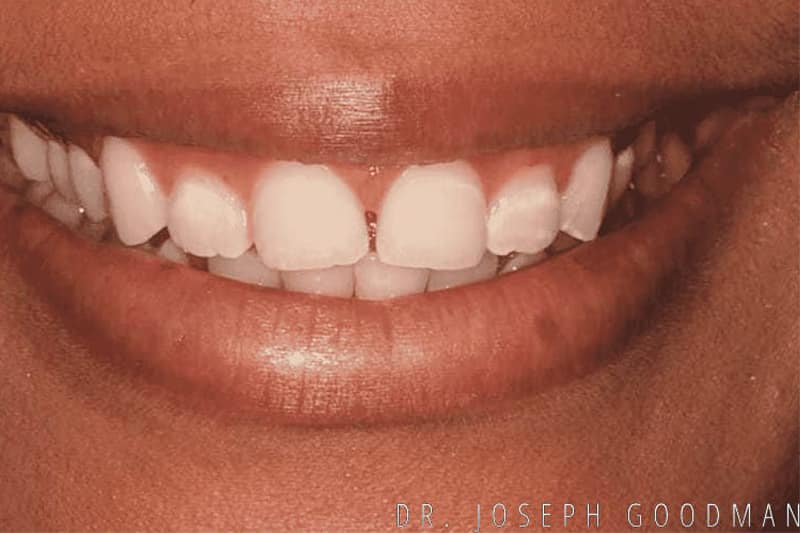 A picture of a client before receiving a smile makeover with 10 porcelain veneers to brighten their smile, done by Dr. Joseph Goodman.