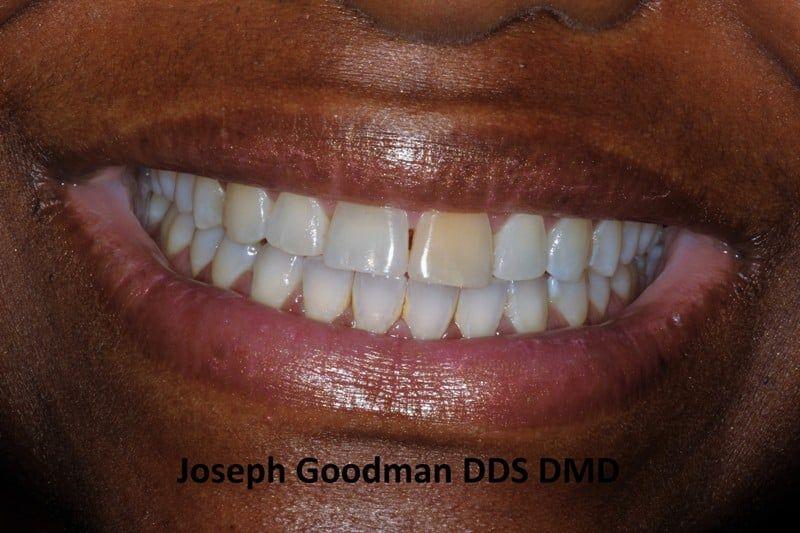 A picture of a client before receiving treatment, done by Dr. Joseph Goodman