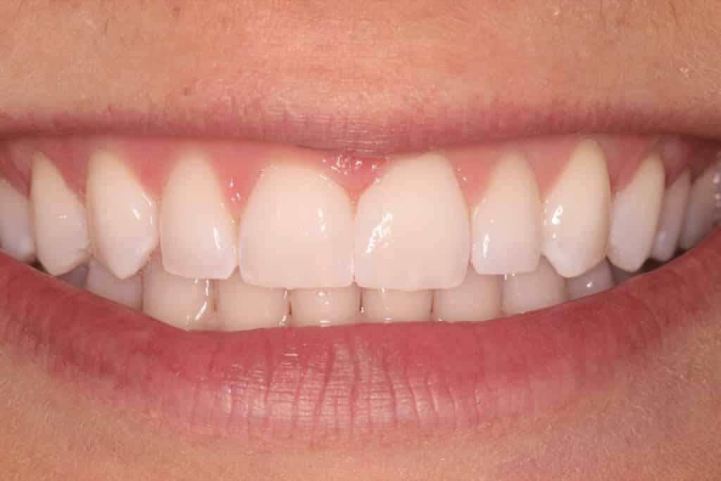 A picture of a client after having a gap closed with dental bonding, done by Dr. Joseph Goodman, the result can last 20 years.