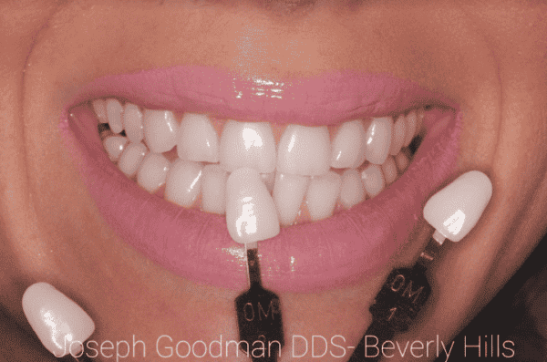 cosmetic dentist veneers1