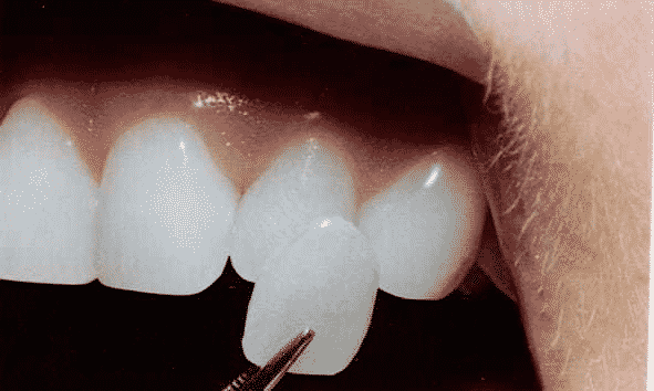 fix a chipped front tooth