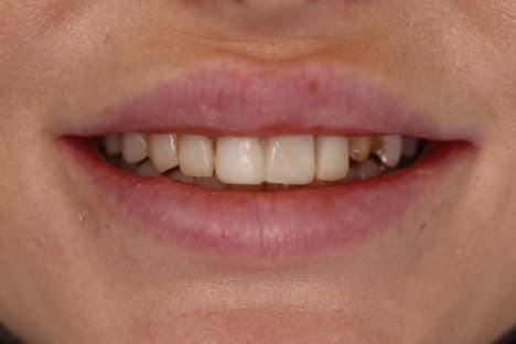 A picture of a client before receiving a smile makeover with full veneers procedure, done by Dr. Joseph Goodman.