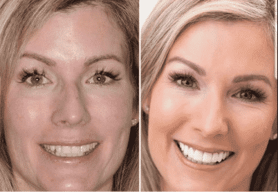 los angeles cosmetic dentistry before and after