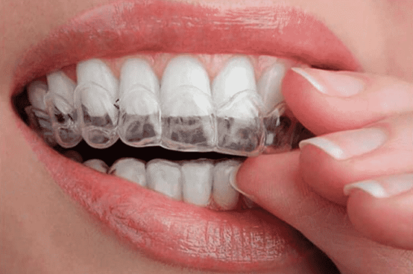 Woman's hand putting transparent aligner in teeth