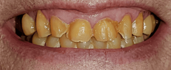 human mouth yellow teet
