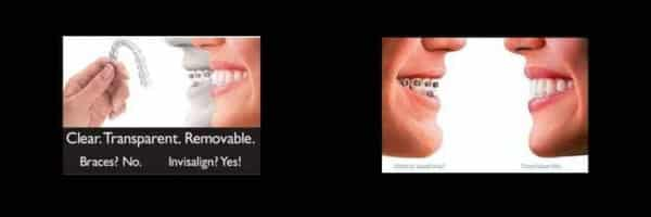 teeth straightening