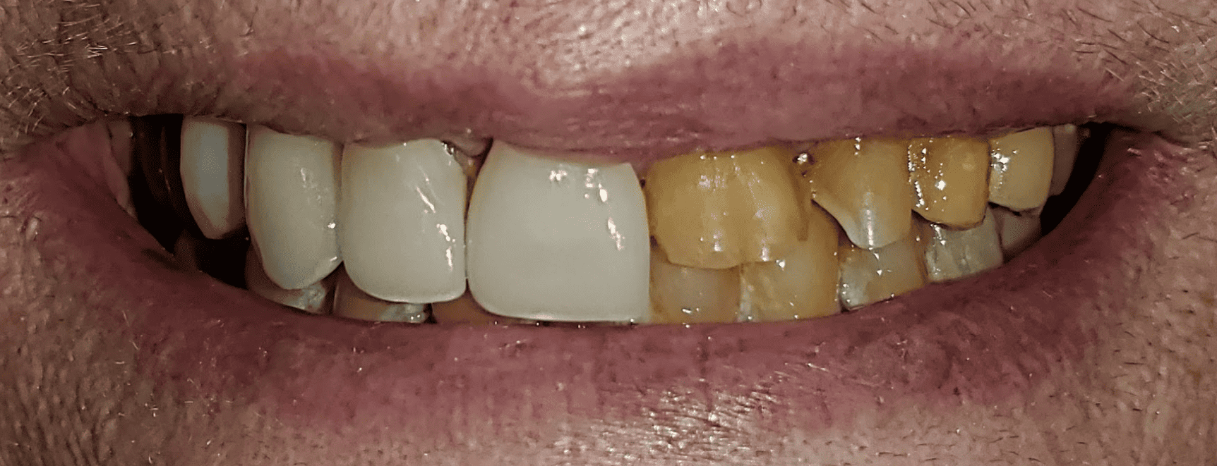 tooth decay