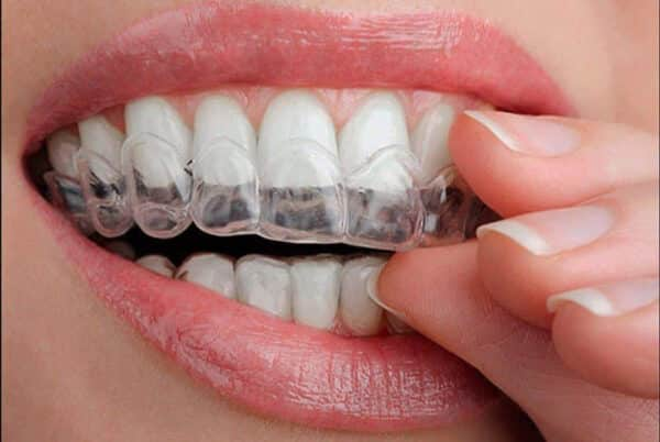 Woman's hand putting transparent aligner in teeth