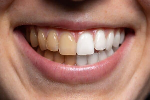 Before and after view of tooth whitening