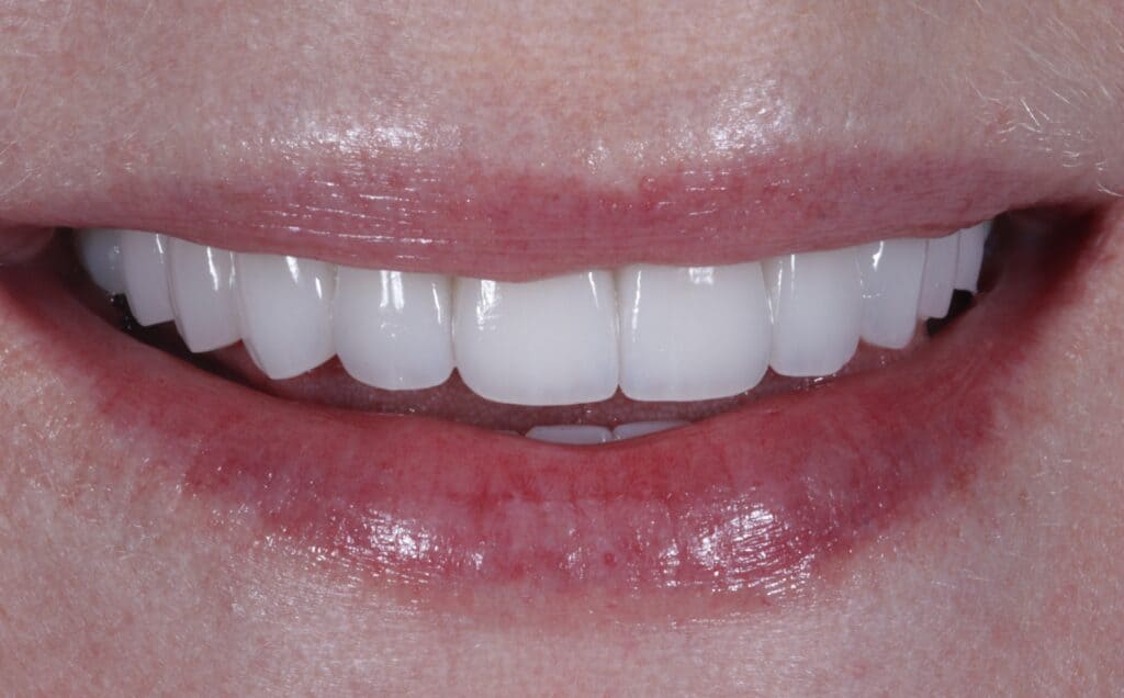 Veneers by Dr.Goodman | Top Beverly Hills Dentist